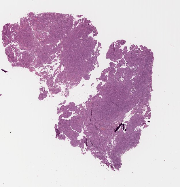 1_Ependymoma.jpg