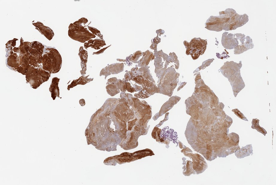 2_2_VestibularSchwannoma.jpg