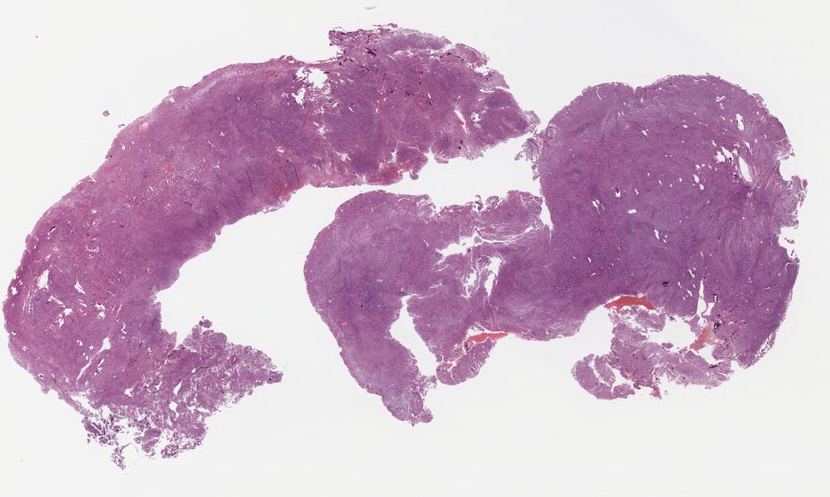 3_Meningioma.jpg