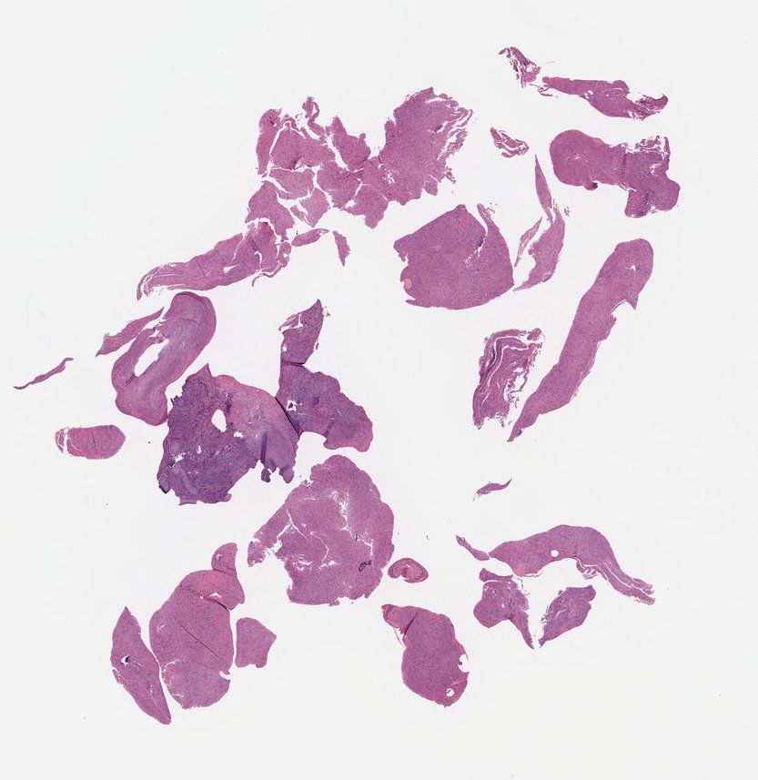 4_VestibularSchwannoma.jpg