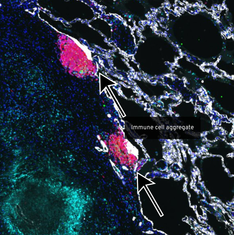 Tuberculosis Granuloma Atlas